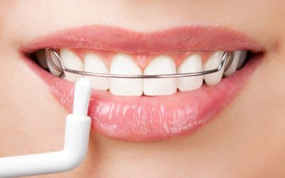 Why Professional Teeth Whitening in Matawan Is The Way To Go